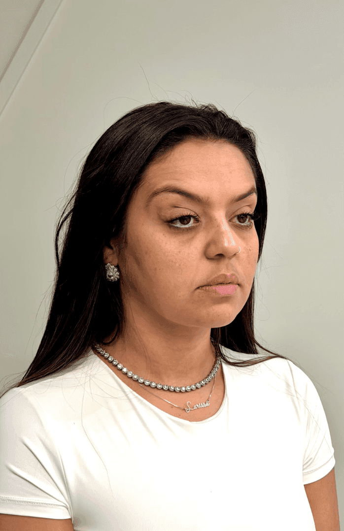 Harmonização Facial — antes e depois