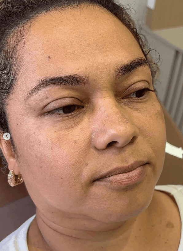 Botox — antes e depois